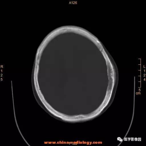 【病例】颞顶部肿物向颅外侵犯——恶性脑膜瘤1例CT 【病例】颞顶部肿物向颅外侵犯——恶性脑膜瘤1例CT