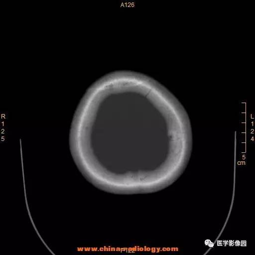 【病例】颞顶部肿物向颅外侵犯——恶性脑膜瘤1例CT 【病例】颞顶部肿物向颅外侵犯——恶性脑膜瘤1例CT