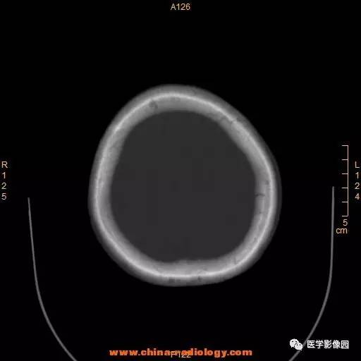 【病例】颞顶部肿物向颅外侵犯——恶性脑膜瘤1例CT 【病例】颞顶部肿物向颅外侵犯——恶性脑膜瘤1例CT