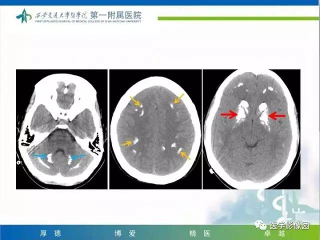 【PPT】儿童基底节病变