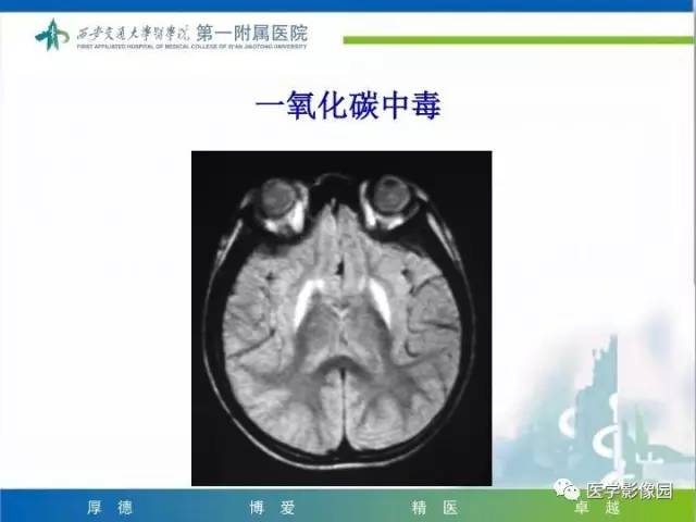 【PPT】儿童基底节病变