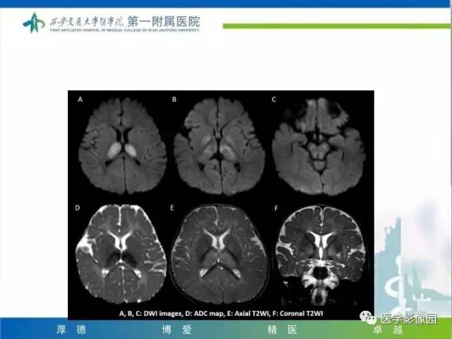 【PPT】儿童基底节病变