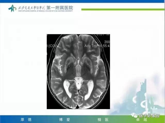 【PPT】儿童基底节病变