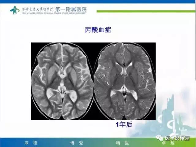 【PPT】儿童基底节病变