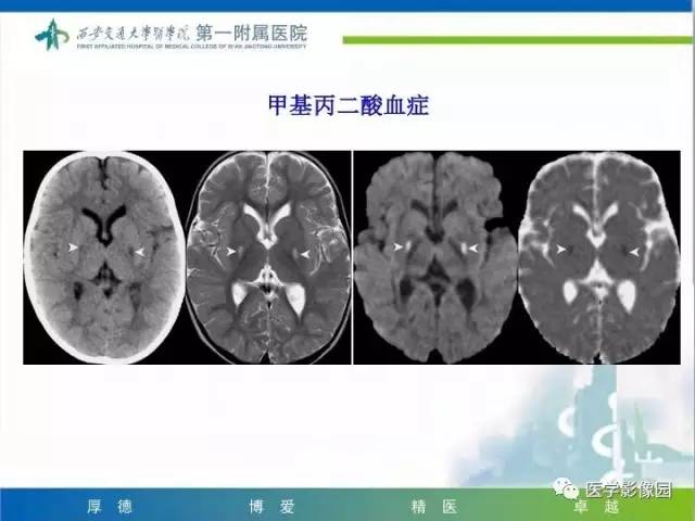 【PPT】儿童基底节病变