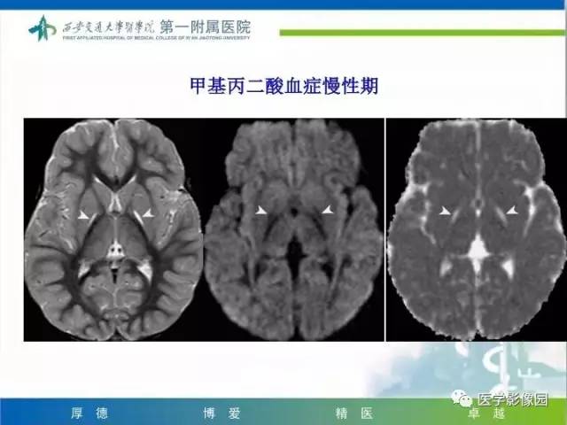【PPT】儿童基底节病变