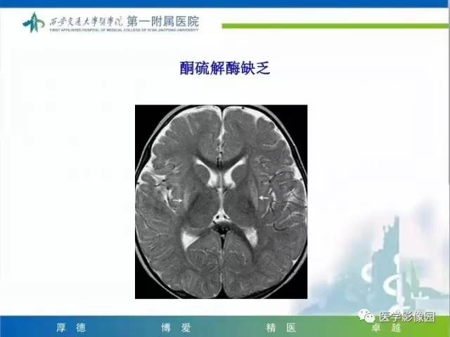 【PPT】儿童基底节病变