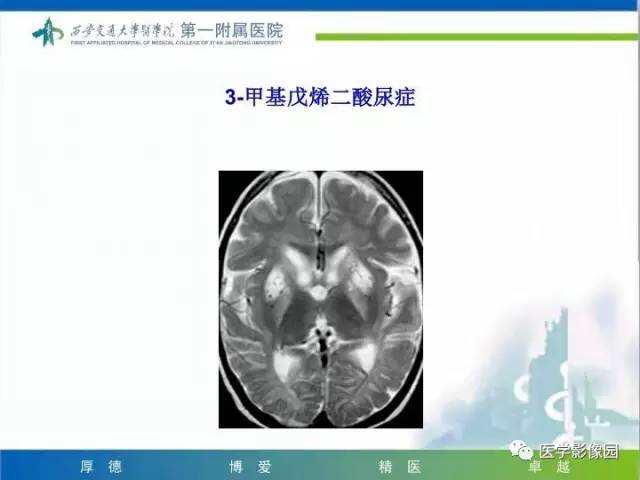 【PPT】儿童基底节病变
