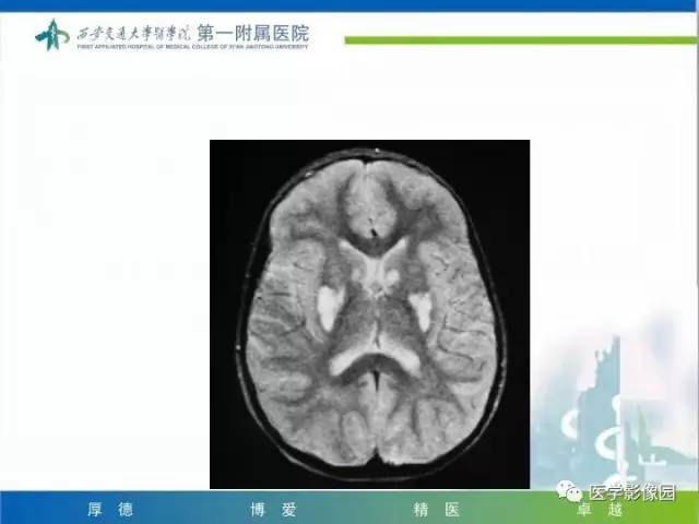 【PPT】儿童基底节病变