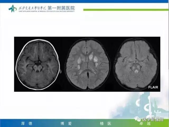 【PPT】儿童基底节病变