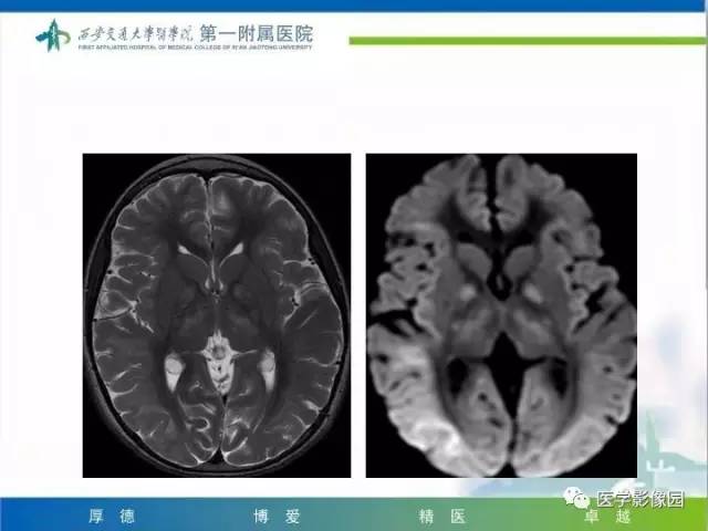 【PPT】儿童基底节病变