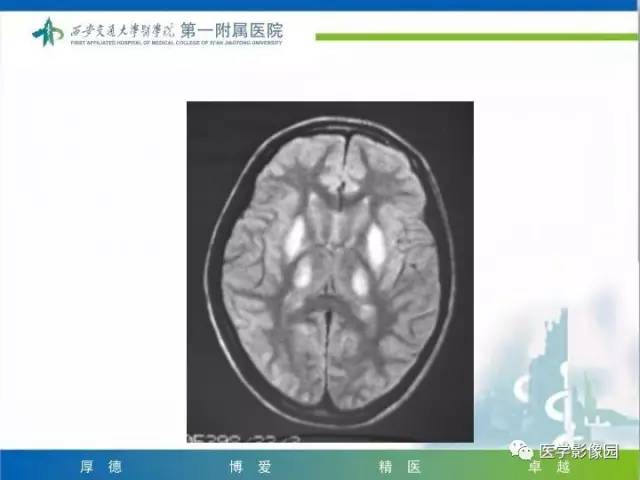【PPT】儿童基底节病变
