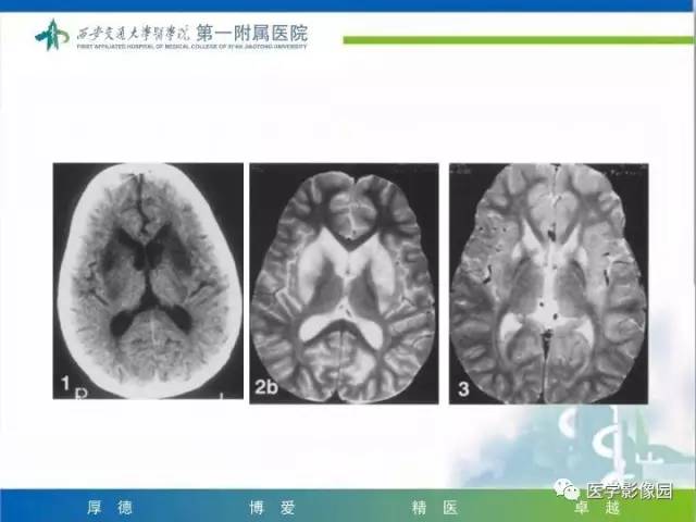 【PPT】儿童基底节病变