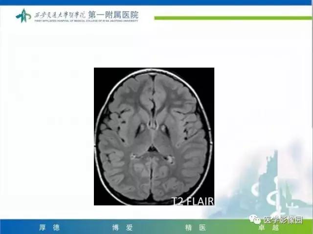 【PPT】儿童基底节病变