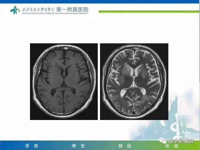 【PPT】儿童基底节病变