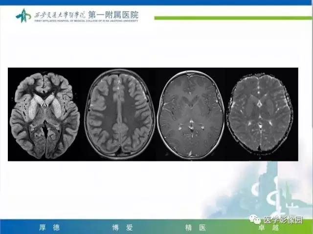 【PPT】儿童基底节病变