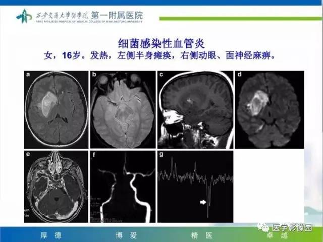 【PPT】儿童基底节病变