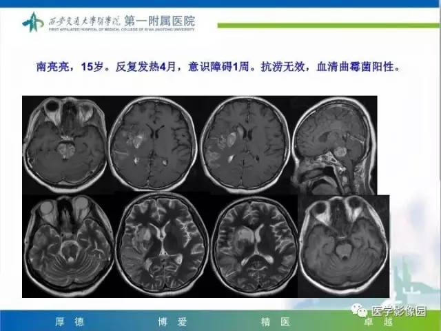 【PPT】儿童基底节病变