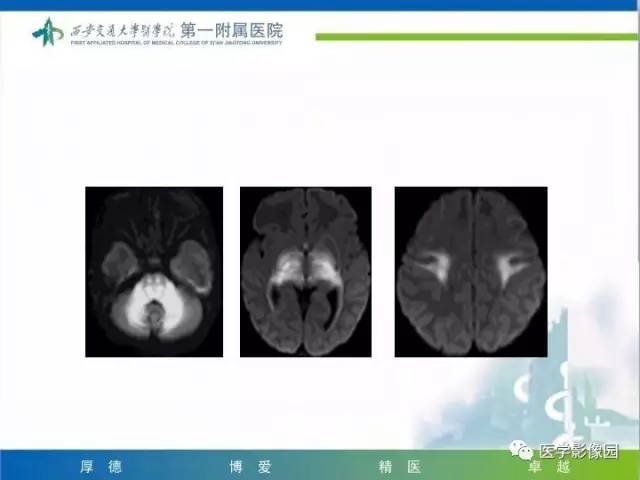 【PPT】儿童基底节病变