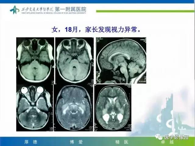 【PPT】儿童基底节病变