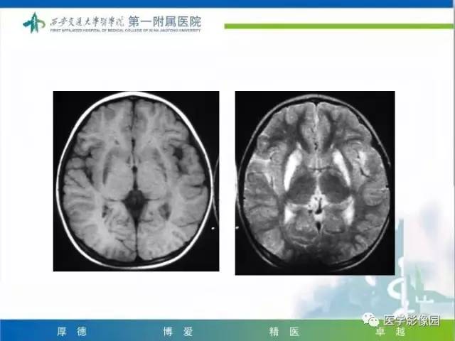 【PPT】儿童基底节病变