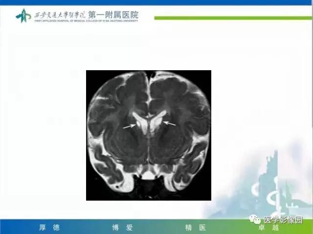 【PPT】儿童基底节病变