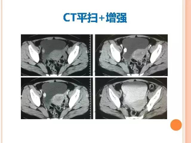 【病例】膀胱副神经节瘤1例CT影像表现