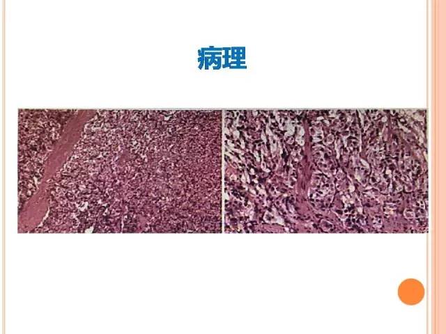 【病例】膀胱副神经节瘤1例CT影像表现