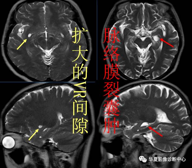 必看:9个连磁共振都可能漏诊或误诊疾病 必看:9个连磁共振都可能漏诊或误诊疾病