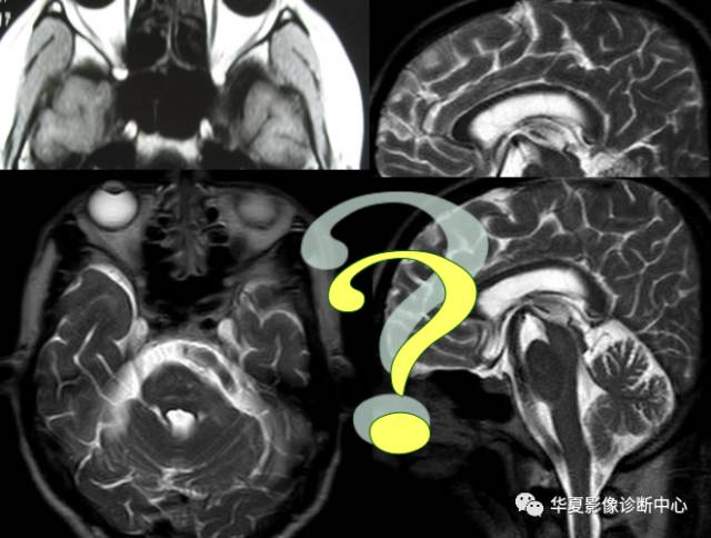 必看：9个连磁共振都可能漏诊或误诊疾病