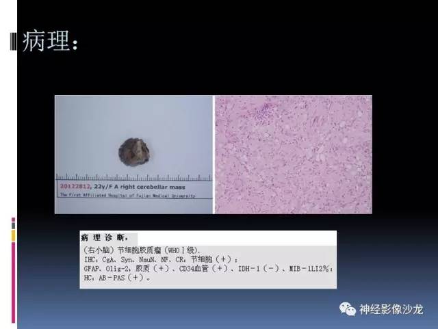 【病例】右小脑节细胞瘤1例MR影像表现