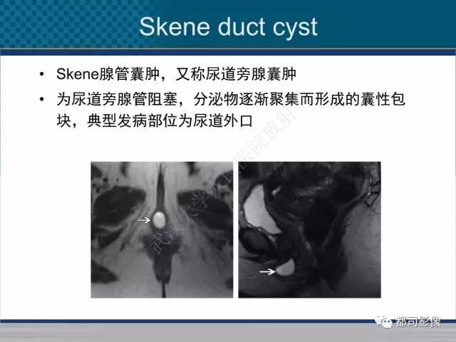 【PPT】女性尿道周围囊肿影像学鉴别诊断