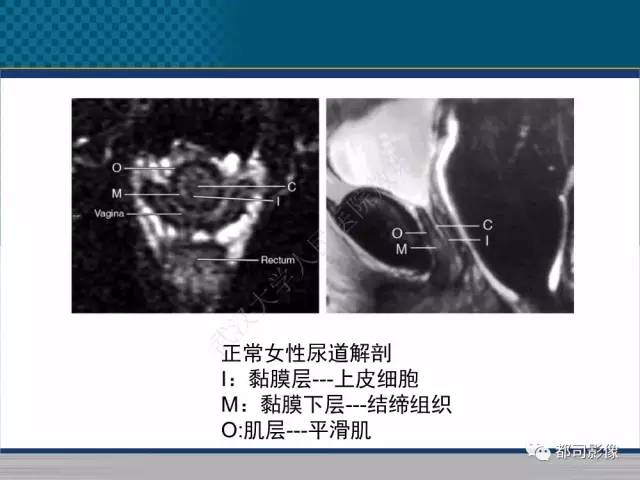 【PPT】女性尿道周围囊肿影像学鉴别诊断