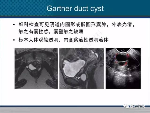 【PPT】女性尿道周围囊肿影像学鉴别诊断