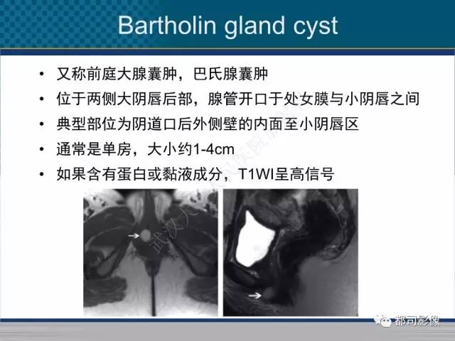 【PPT】女性尿道周围囊肿影像学鉴别诊断