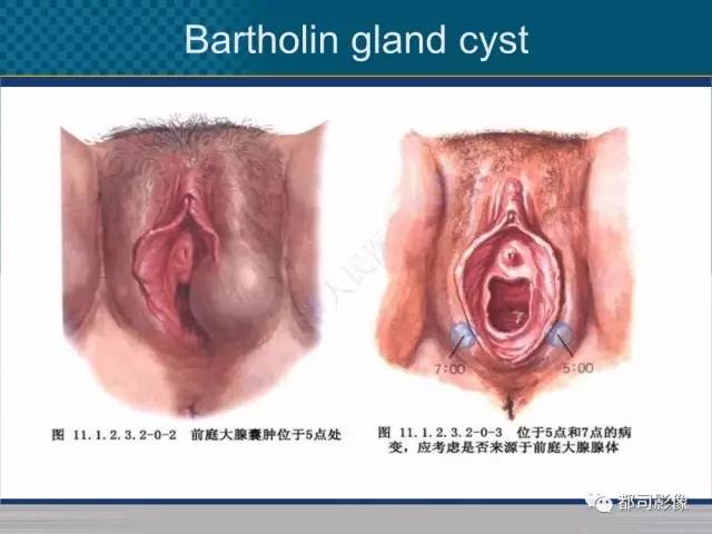 【PPT】女性尿道周围囊肿影像学鉴别诊断