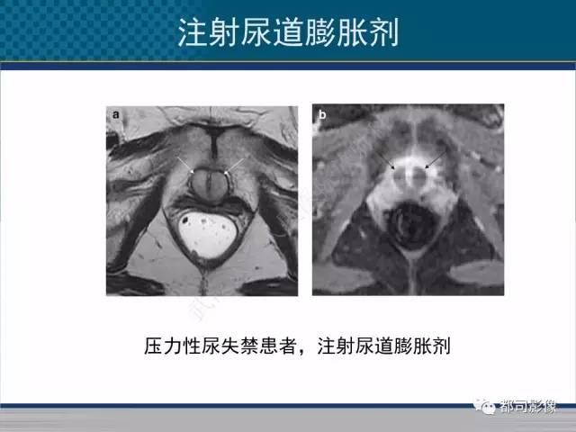 【PPT】女性尿道周围囊肿影像学鉴别诊断