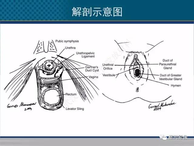 【PPT】女性尿道周围囊肿影像学鉴别诊断