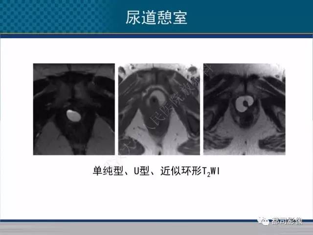 【PPT】女性尿道周围囊肿影像学鉴别诊断