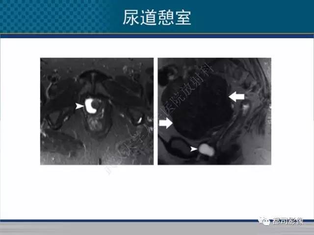【PPT】女性尿道周围囊肿影像学鉴别诊断