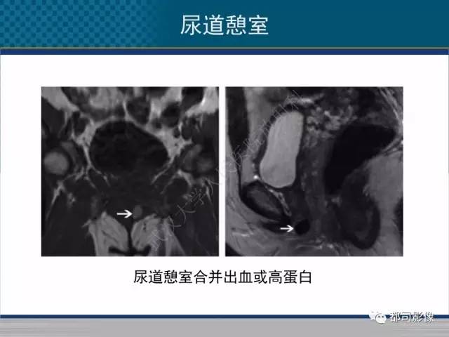【PPT】女性尿道周围囊肿影像学鉴别诊断