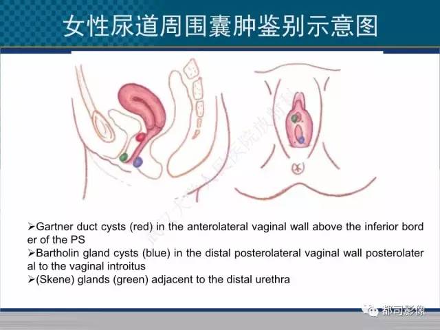 【PPT】女性尿道周围囊肿影像学鉴别诊断