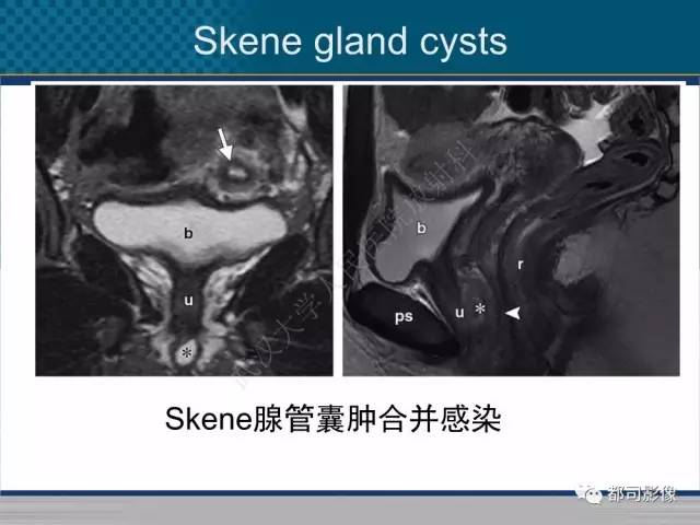 【PPT】女性尿道周围囊肿影像学鉴别诊断