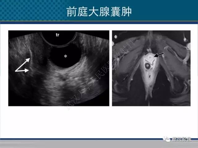 【PPT】女性尿道周围囊肿影像学鉴别诊断