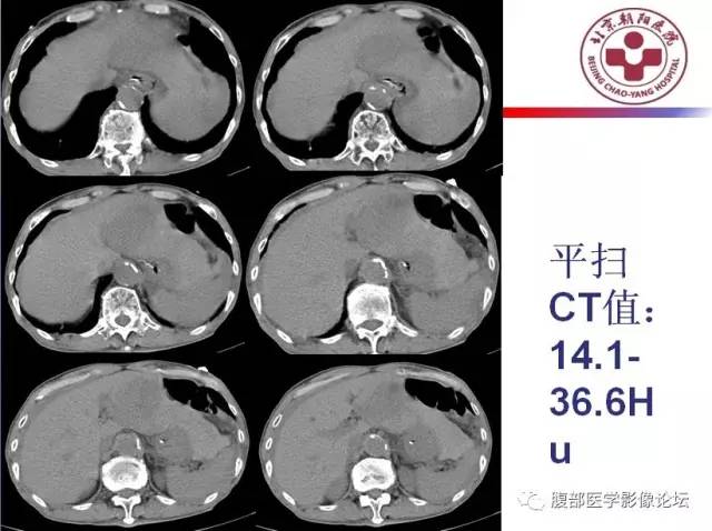 【病例】肝左外叶腺神经内分泌癌1例CT