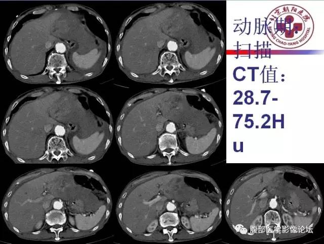 【病例】肝左外叶腺神经内分泌癌1例CT
