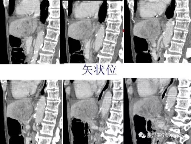 【病例】肝左外叶腺神经内分泌癌1例CT