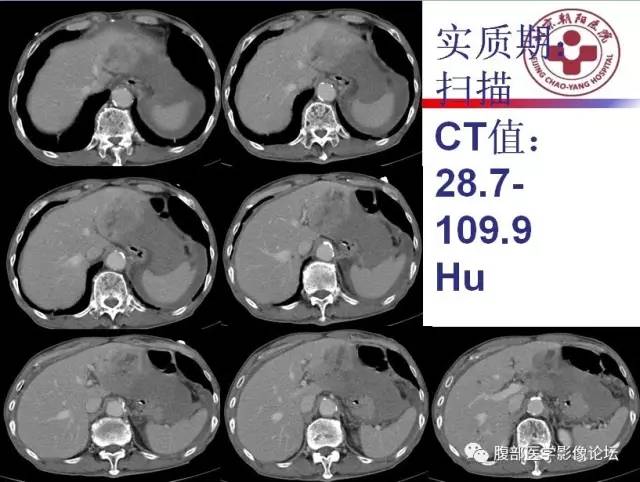 【病例】肝左外叶腺神经内分泌癌1例CT