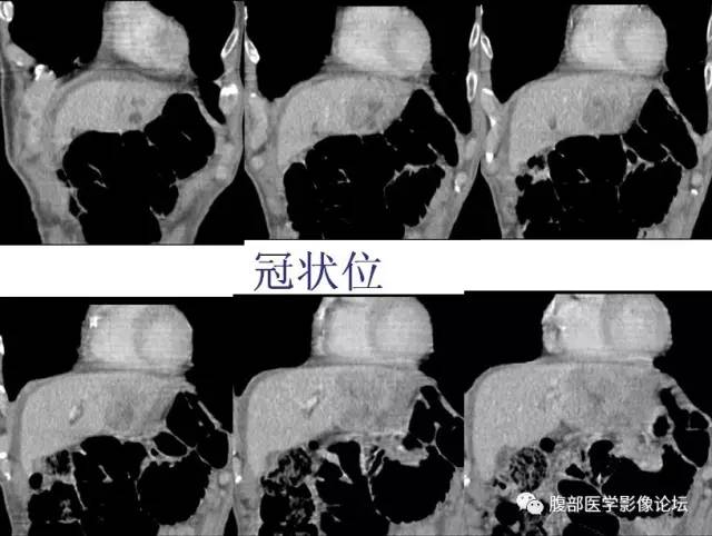 【病例】肝左外叶腺神经内分泌癌1例CT