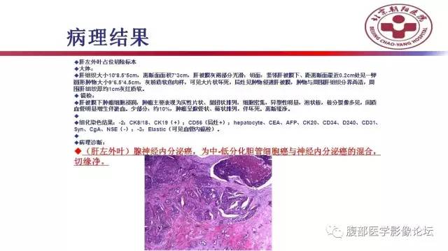 【病例】肝左外叶腺神经内分泌癌1例CT